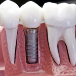 dental implant in austin tx