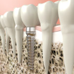 Austin Implant dentist