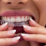 Clearcorrect Austin | Clearcorrect Austin Texas